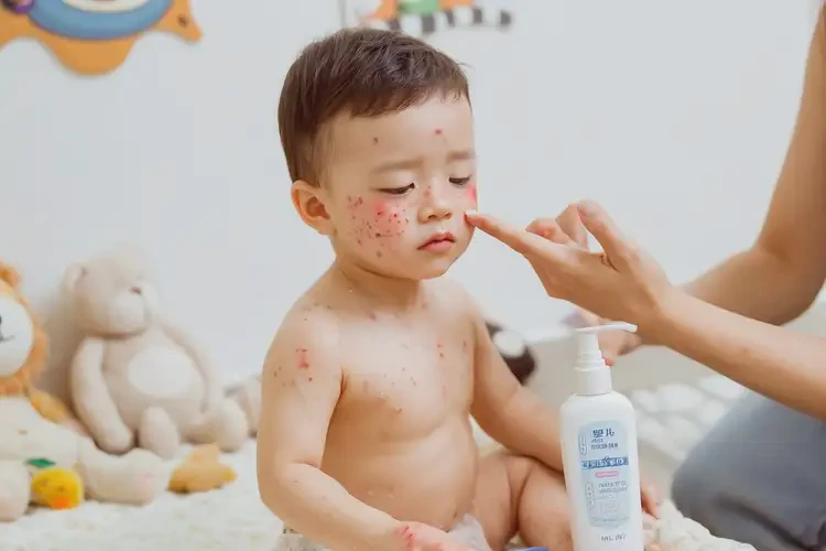 幼兒面部出現(xiàn)濕疹不管它會自己自愈嗎(圖3)