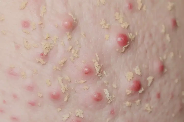 女生臉上出濕疹不管它會(huì)自己好嗎(圖2)