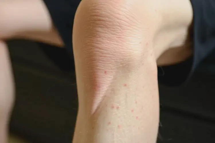 老人小腿上偶爾起濕疹不管它會(huì)自己好嗎(圖1)