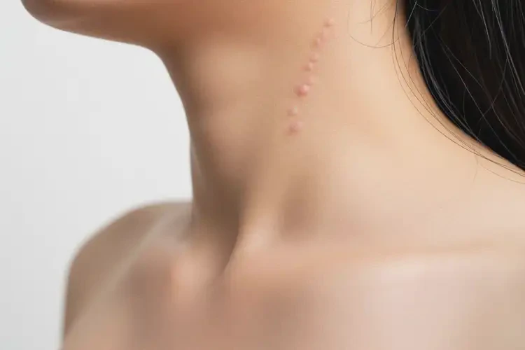 孕婦脖子上偶爾起濕疹不管它會自己痊愈嗎(圖2)