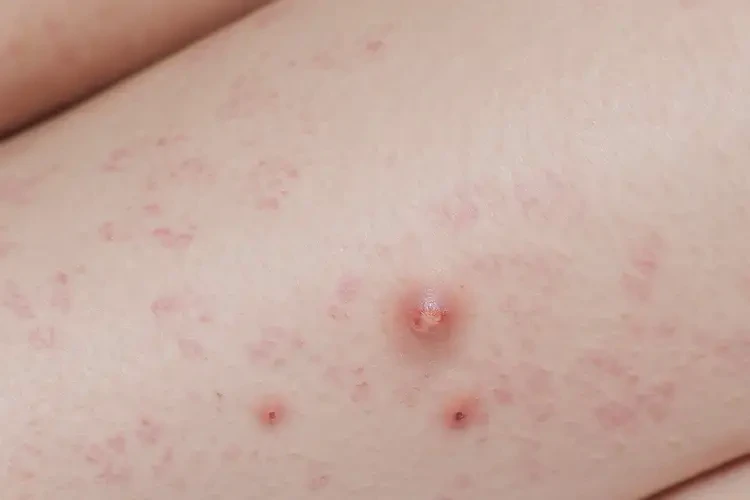 中學(xué)生小腿上經(jīng)常起濕疹可以徹底自愈嗎(圖4)