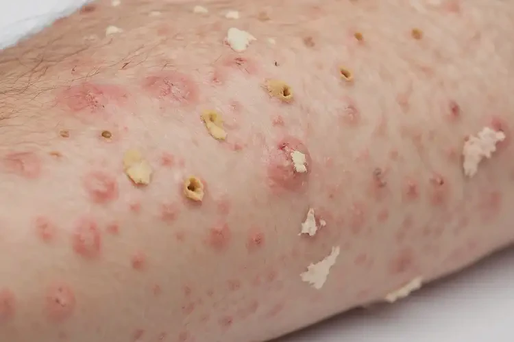 大學(xué)生肚子長(zhǎng)濕疹不管它會(huì)自己好嗎(圖3)