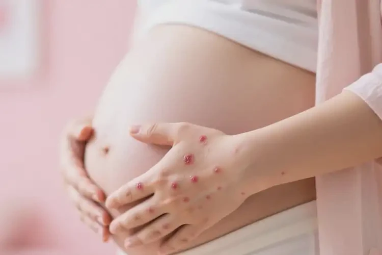 孕婦手上長濕疹不管它會自己自愈嗎(圖3)