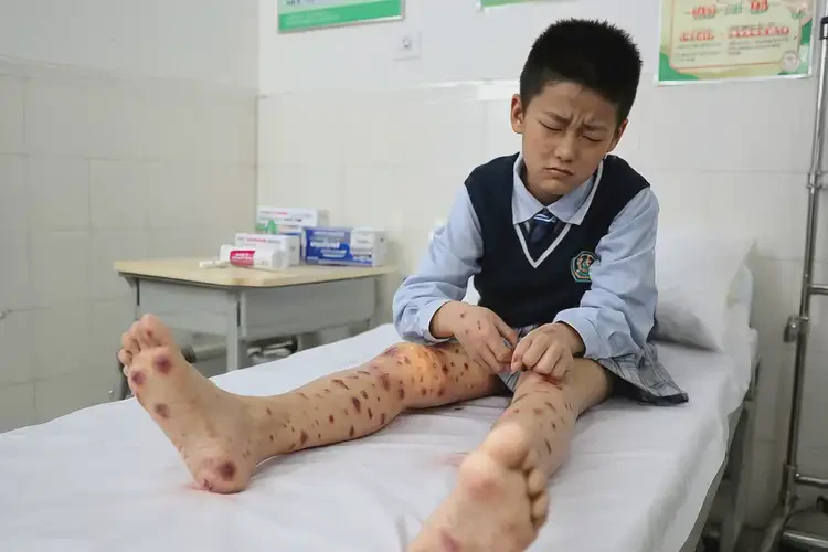 中學生腳上長濕疹能夠徹底治愈嗎(圖4)