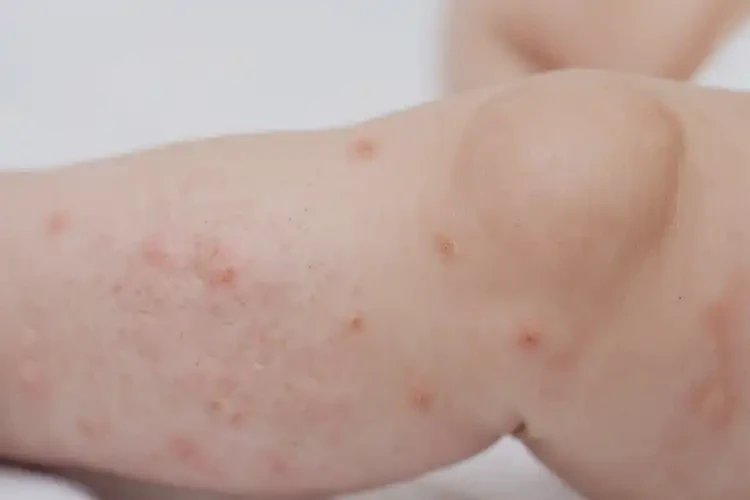 幼兒小腿上起濕疹能靠自己自愈嗎(圖4)