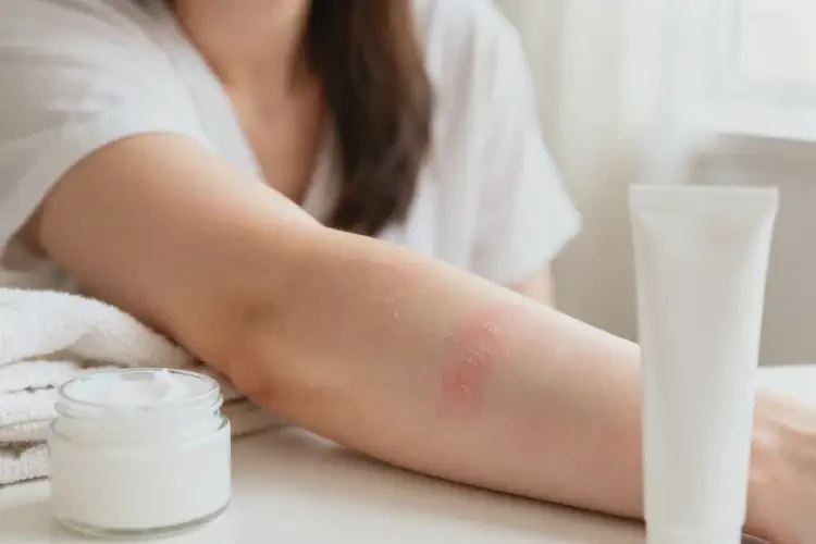 女生手臂長濕疹能靠自己自愈嗎(圖3)