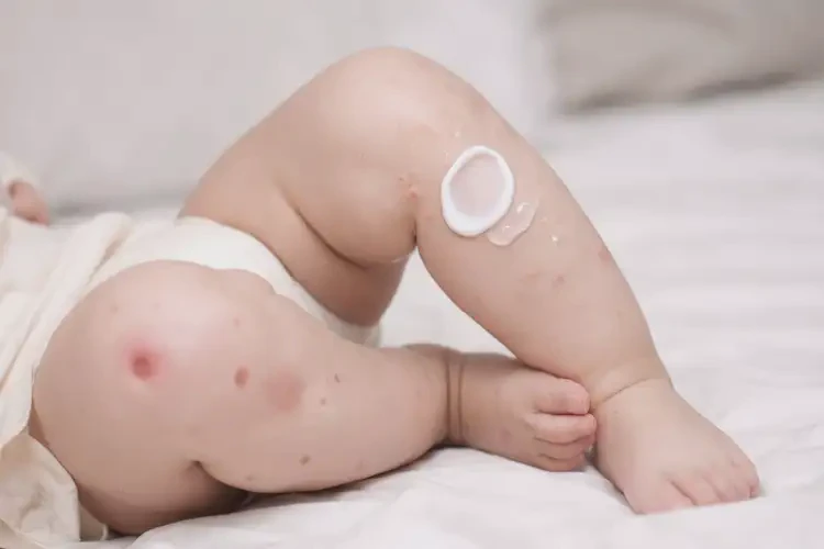 寶寶大腿上有濕疹能徹底自愈嗎(圖2)