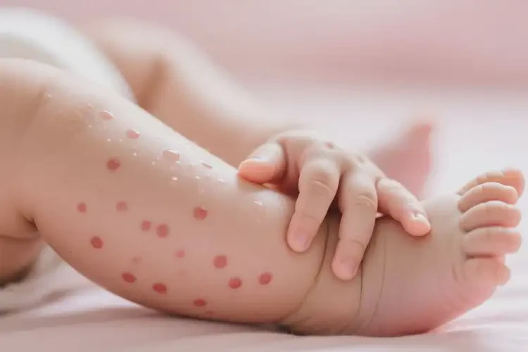 新生儿小腿上容易长湿疹不管它会自己自愈吗(图1)