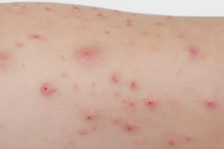 小孩手臂上出现湿疹不管它会自己自愈吗(图3)