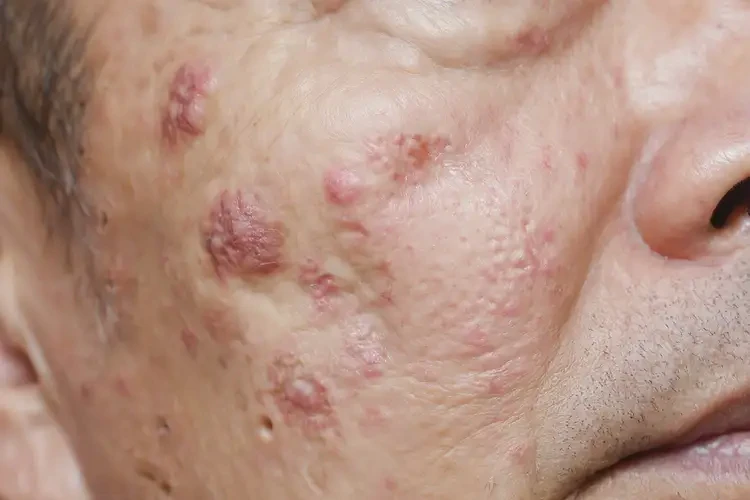 男性屁股起濕疹不管它會自己痊愈嗎(圖4)