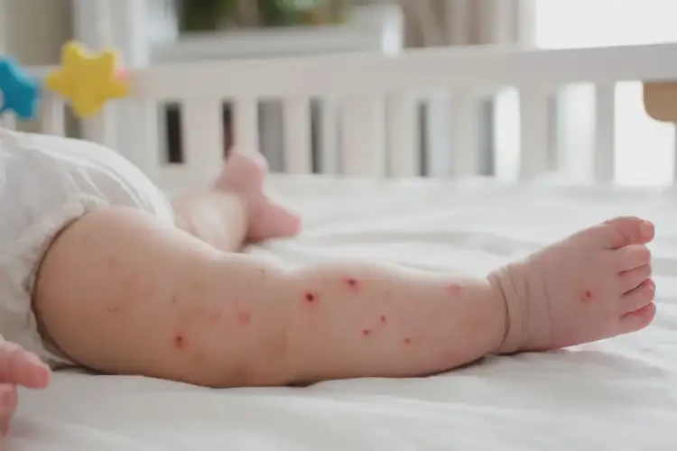 寶寶四肢偶爾長(zhǎng)濕疹可以徹底自愈嗎(圖4)