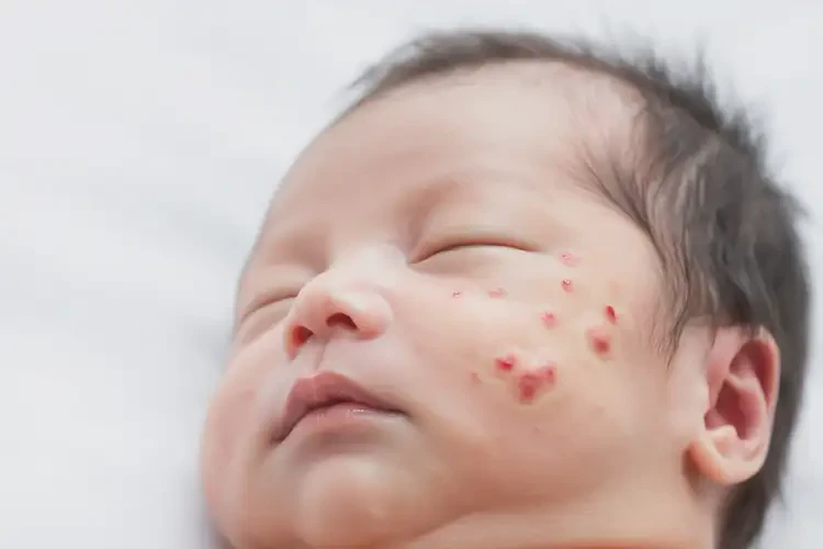 新生兒臉上經常長濕疹可以徹底自愈嗎(圖4)