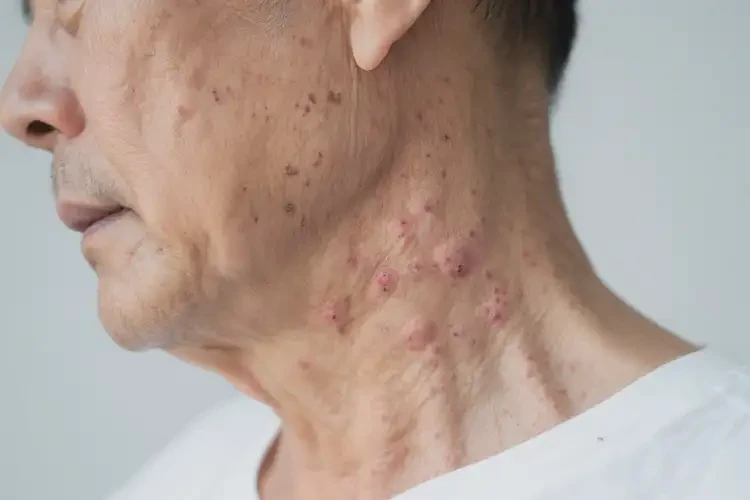 男性脖子偶尔起湿疹能靠自己自愈吗(图1)