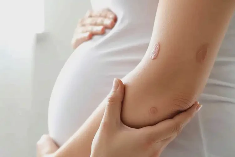 產(chǎn)婦手臂上偶爾起濕疹可不可以徹底自愈(圖1)