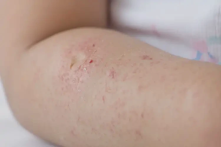 小兒手臂容易長(zhǎng)濕疹能夠徹底治愈嗎(圖4)