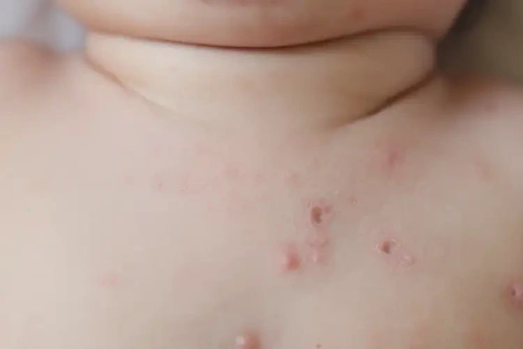 孩子脖子上偶爾長濕疹可不可以徹底自愈(圖4)