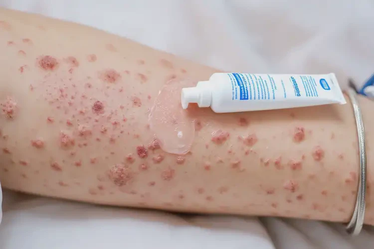 產(chǎn)婦手臂起濕疹能靠自己自愈嗎(圖2)