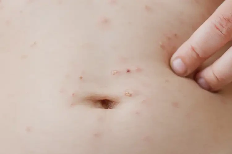 小兒肚子出現(xiàn)濕疹可不可以徹底自愈(圖4)