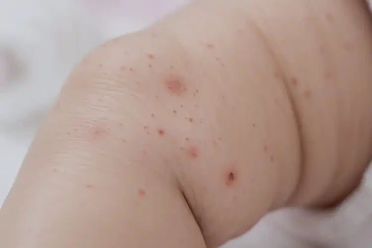 嬰兒小腿上有濕疹可以徹底自愈嗎(圖4)