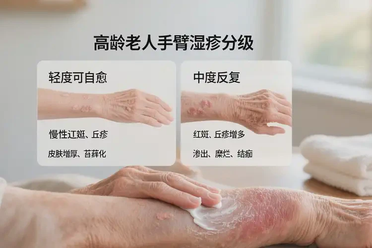 高龄老人手臂上出现湿疹能不能彻底自愈(图1)