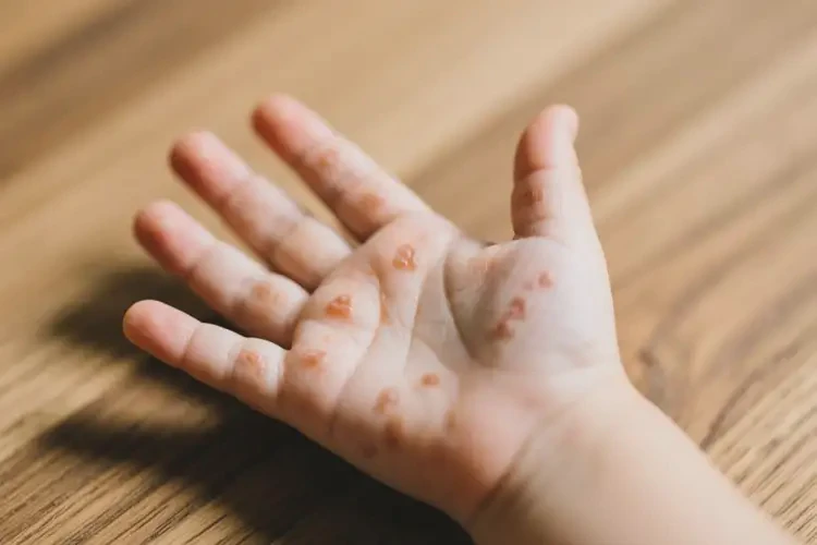 幼兒手上有濕疹不管它會(huì)自己痊愈嗎(圖1)