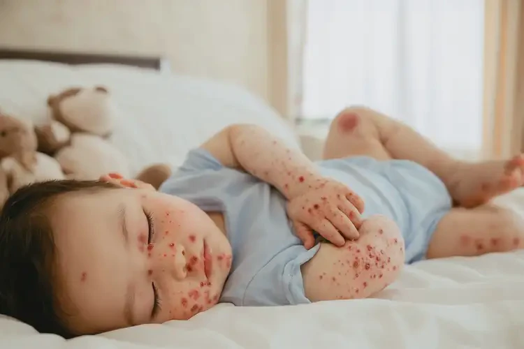 幼兒肚子上經(jīng)常起濕疹能不能徹底自愈(圖3)