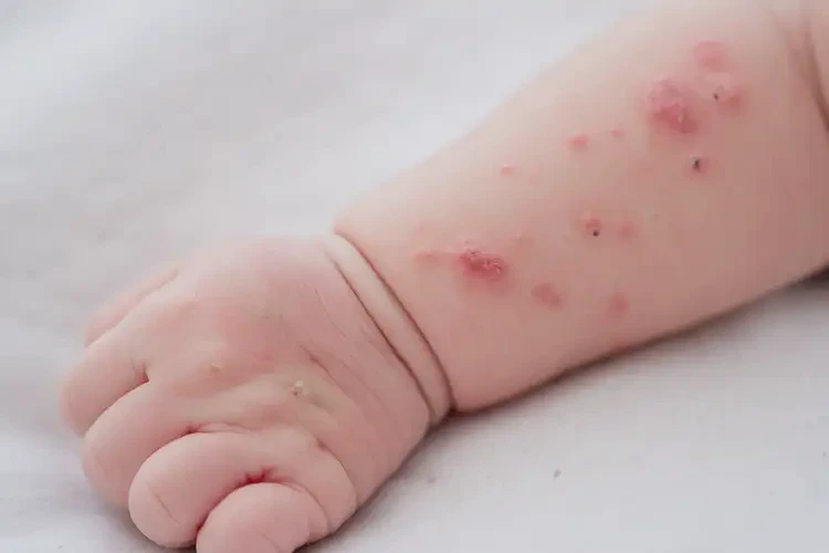 新生兒手臂偶爾起濕疹能夠徹底治愈嗎(圖4)
