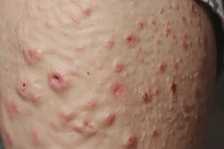 老年人大腿上出現(xiàn)濕疹能夠徹底治愈嗎(圖4)