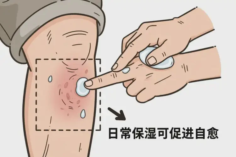 老人小腿上容易起濕疹能靠自己自愈嗎(圖2)