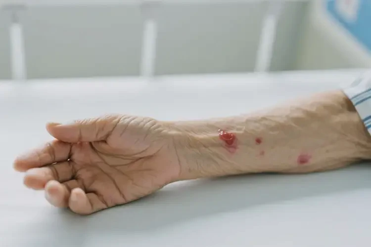 高齡老人手臂上偶爾長濕疹不管它會(huì)自己痊愈嗎(圖4)