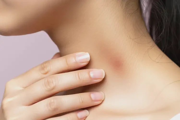 女生脖子容易长湿疹不管它会自己好吗(图3)