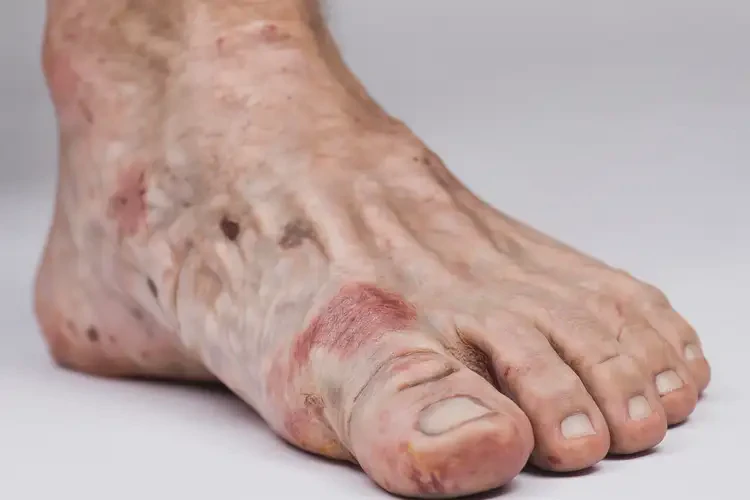 男性腳上經(jīng)常長濕疹不管它會自己好嗎(圖3)