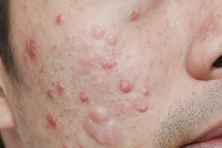 青年人面部有濕疹能夠徹底治愈嗎(圖4)