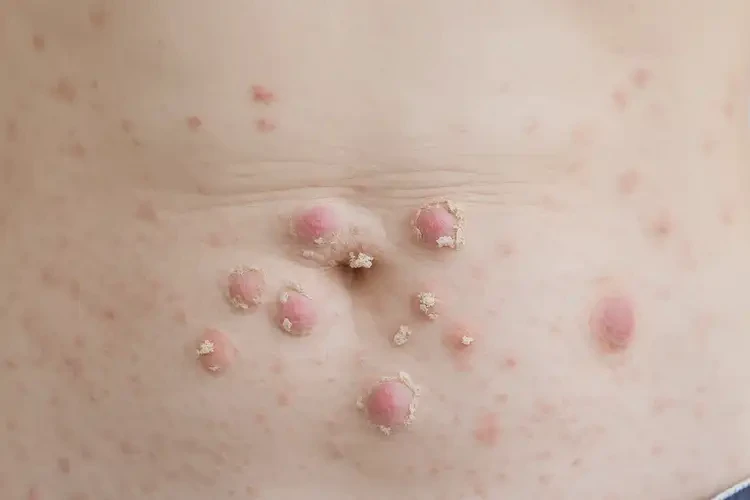 女性肚子上出濕疹可不可以徹底自愈(圖3)