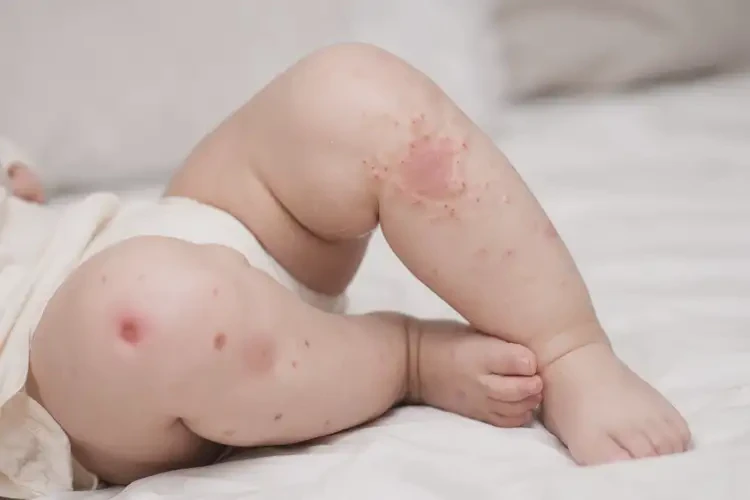 寶寶大腿上有濕疹能徹底自愈嗎(圖3)