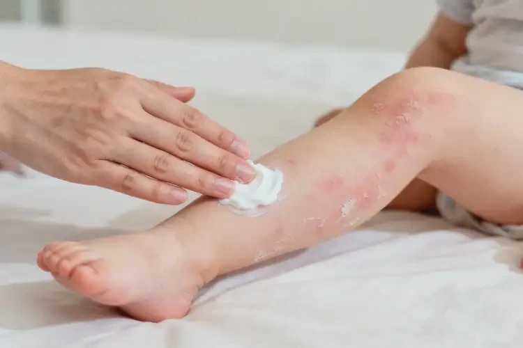 幼兒小腿有濕疹不管它會自己自愈嗎(圖1)