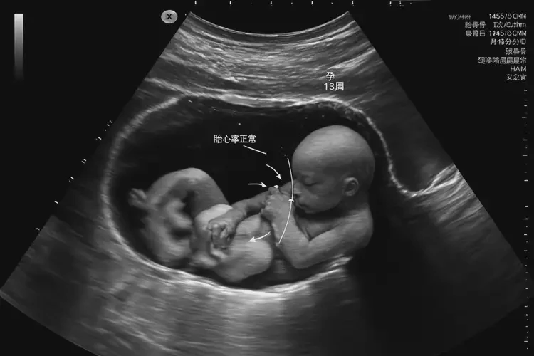 孕13周2天胎心100多有危險(xiǎn)嗎(圖4)