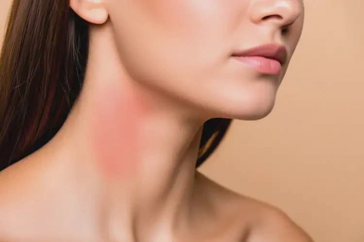 女人脖子有濕疹不管它會(huì)自己好嗎(圖4)