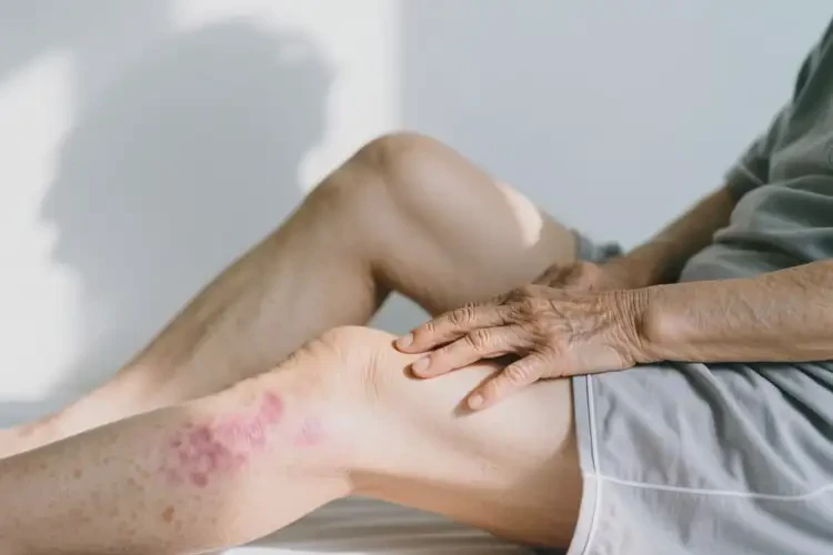 老年人大腿偶爾起濕疹可以徹底自愈嗎(圖1)