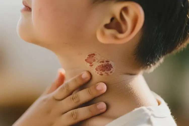 小孩脖子經(jīng)常起濕疹能夠徹底治愈嗎(圖3)