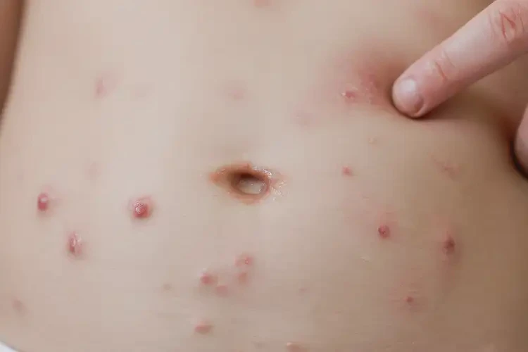 少兒肚子上經常起濕疹能徹底自愈嗎(圖4)