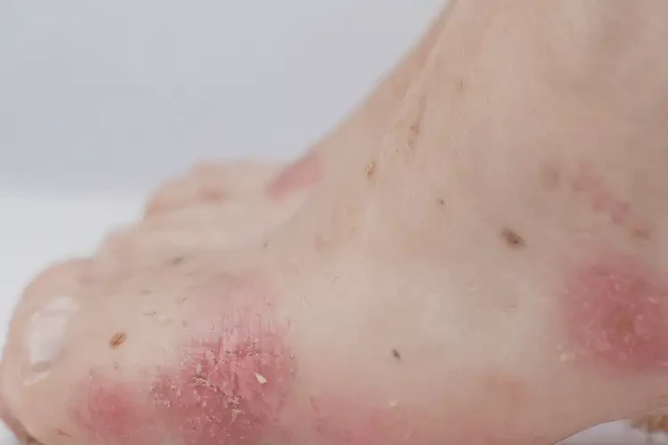 中学生脚上出湿疹能靠自己自愈吗(图4)