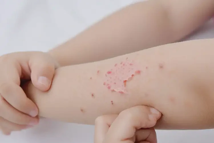 小學(xué)生手臂上偶爾起濕疹能夠徹底治愈嗎(圖4)