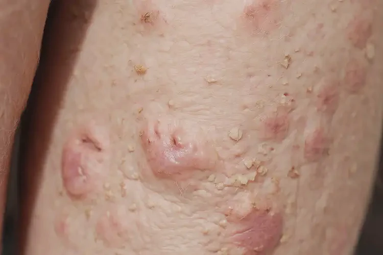 老年人小腿上經(jīng)常長濕疹能徹底自愈嗎(圖4)