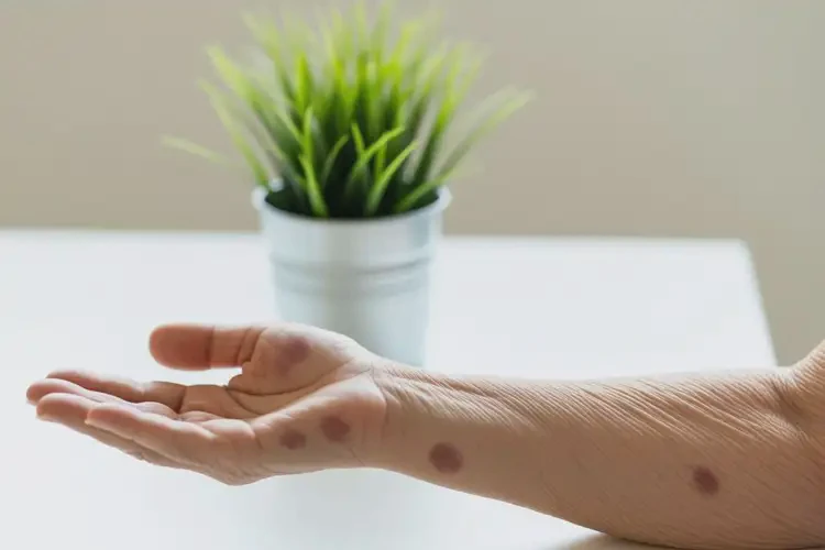 老人手臂上長濕疹能靠自己自愈嗎(圖2)