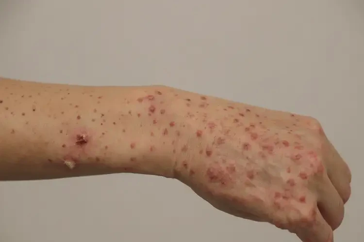 女人手上出現(xiàn)濕疹可以徹底自愈嗎(圖4)