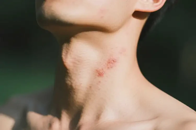 男人脖子上容易起濕疹可不可以徹底自愈(圖3)