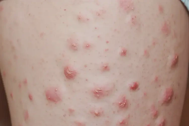 中學(xué)生大腿容易起濕疹能徹底自愈嗎(圖4)