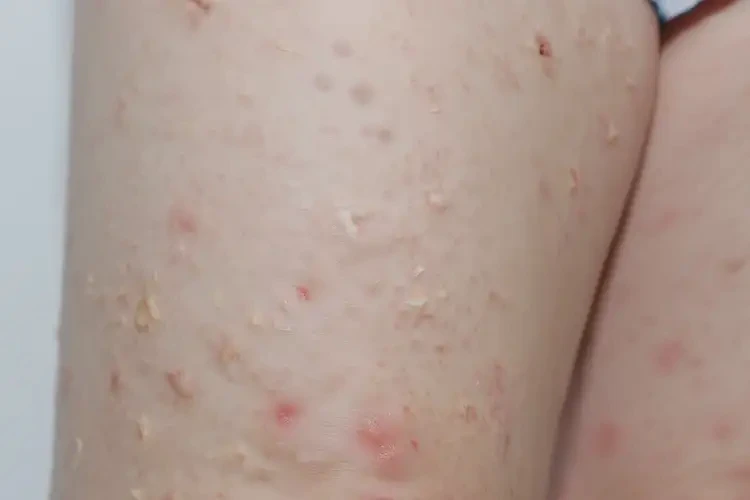 兒童大腿偶爾長濕疹不管它會(huì)自己痊愈嗎(圖1)