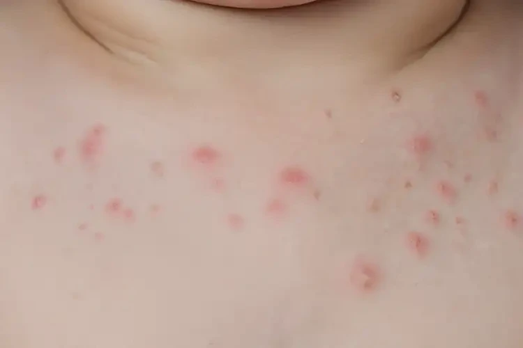 婴幼儿脖子上起湿疹可以彻底自愈吗(图4)